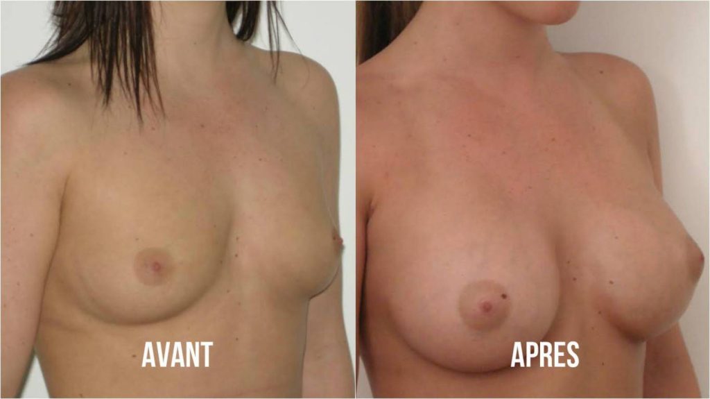 un avant / après d'une augmentation mammaire