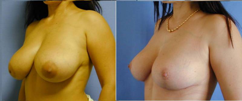 un avant / après d'une chirurgie mammaire